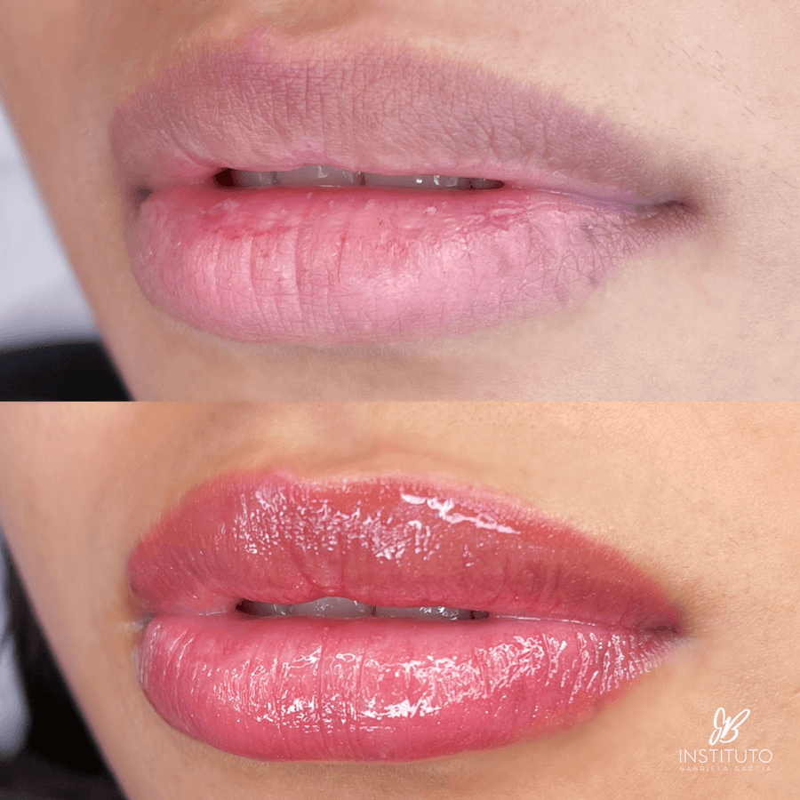 Revitalização Labial